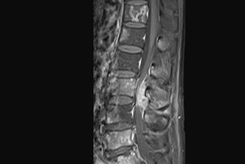 Tumeurs du dos et métastases – pathologie néoplasique à Bienne