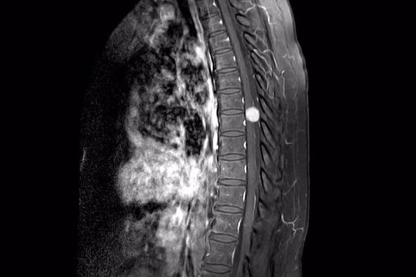 Tumeurs du dos et métastases – pathologie néoplasique à Bienne