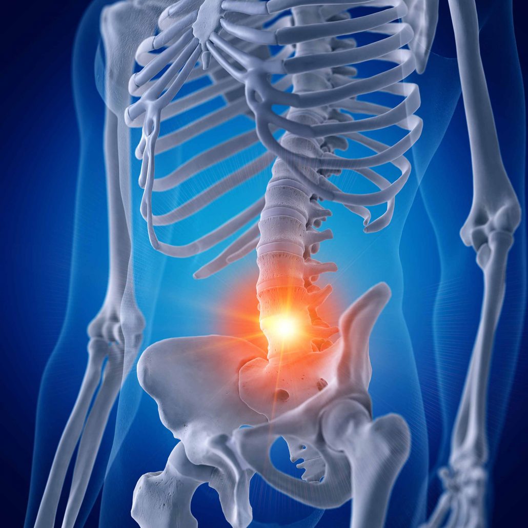 Akuter Bandscheibenvorfall Diskushernie erfolgreich behandeln in Biel